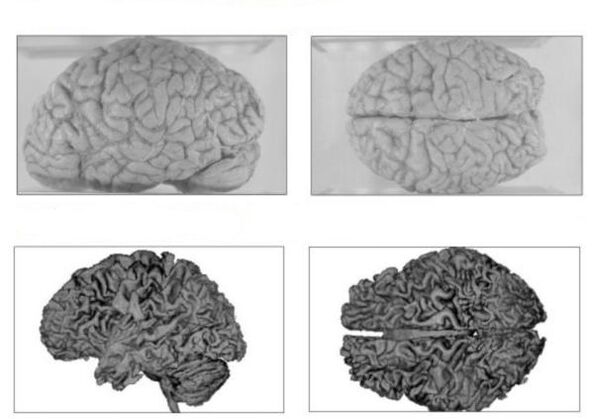 Il cervello di una persona sana (sopra) e il cervello di un alcolizzato con conseguenze irreversibili (sotto)