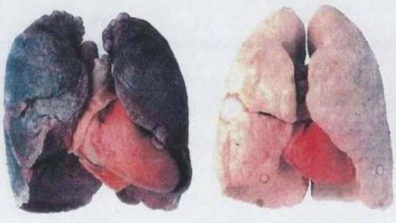 Molti alcolisti cronici muoiono per danni ai polmoni (a sinistra)